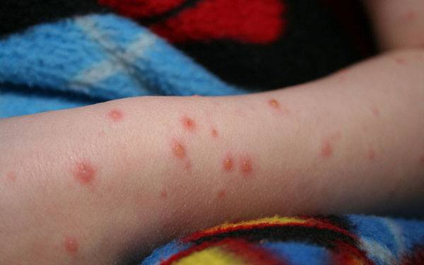 can kids fly with chickenpox